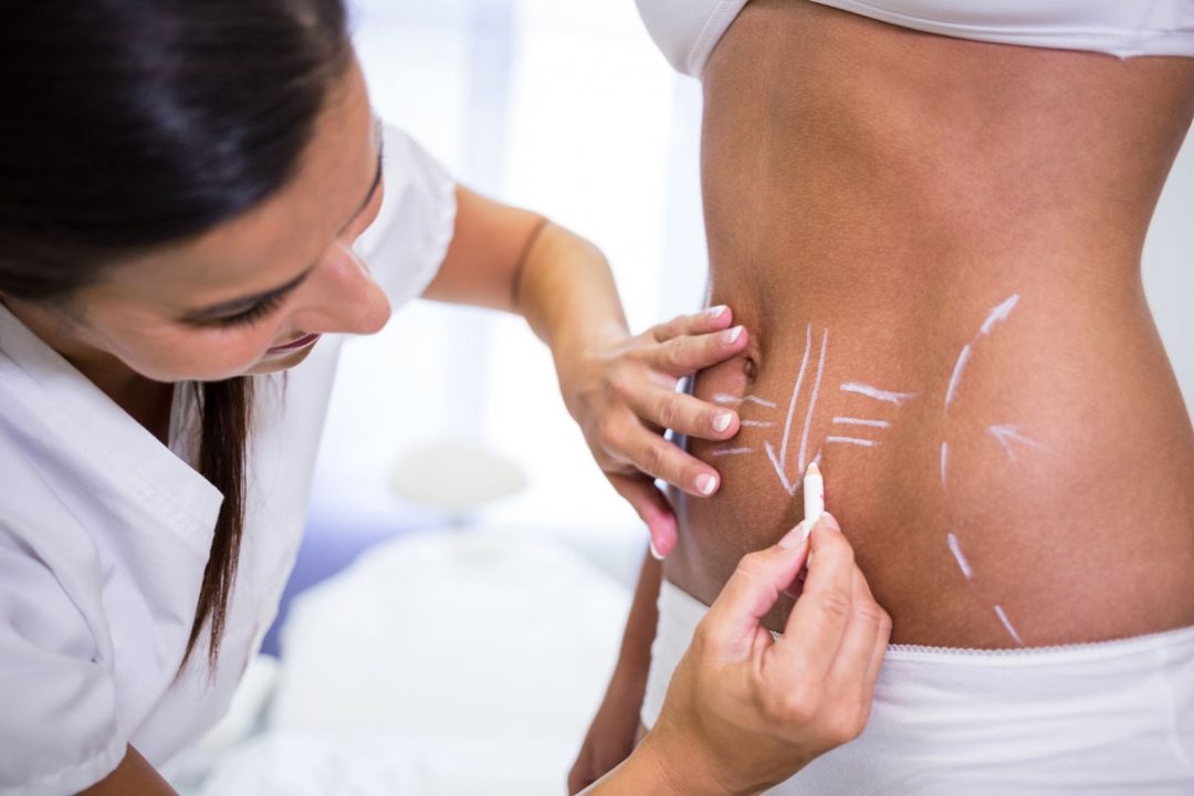 Surgeon drawing lines on woman's abdomen for liposuction